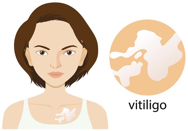Vitiligo: o que é, causas, sintomas e tratamento 